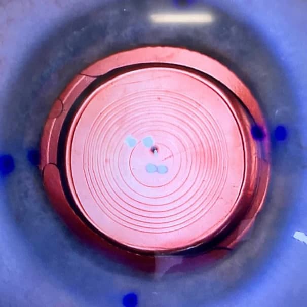 Trifocal