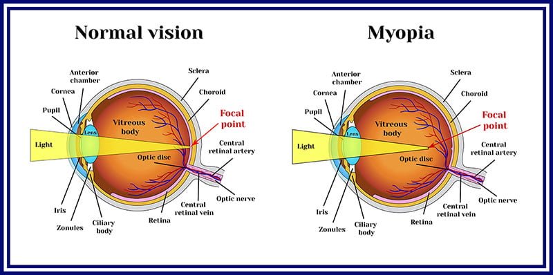 Nearsightedness, myopia